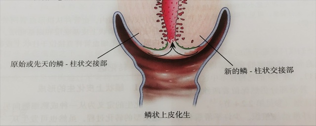 宮頸癌篩查沒(méi)那么簡(jiǎn)單，這些技巧助你提高取樣質(zhì)量