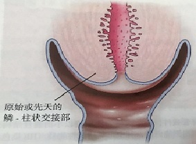 宮頸癌篩查沒(méi)那么簡(jiǎn)單，這些技巧助你提高取樣質(zhì)量